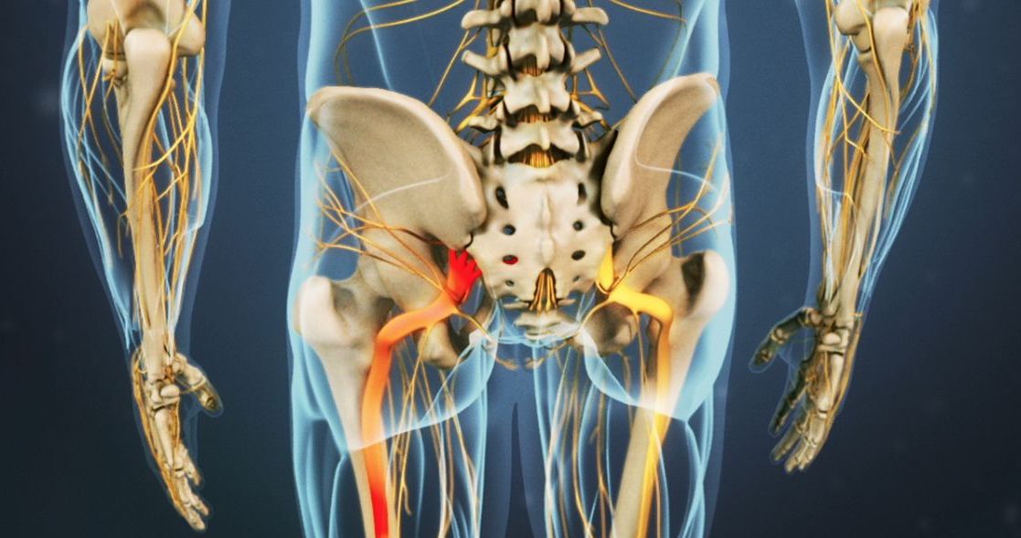 Back Pain Causes Sciatica