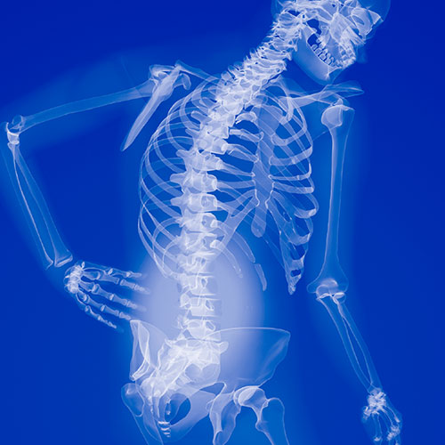 Kyphosis: Symptoms, Causes, Diagnosis, and Treatment - KKT Pakistan