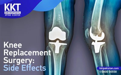 Knee Replacement Surgery: Side Effects