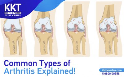 Common Types of Arthritis Explained!