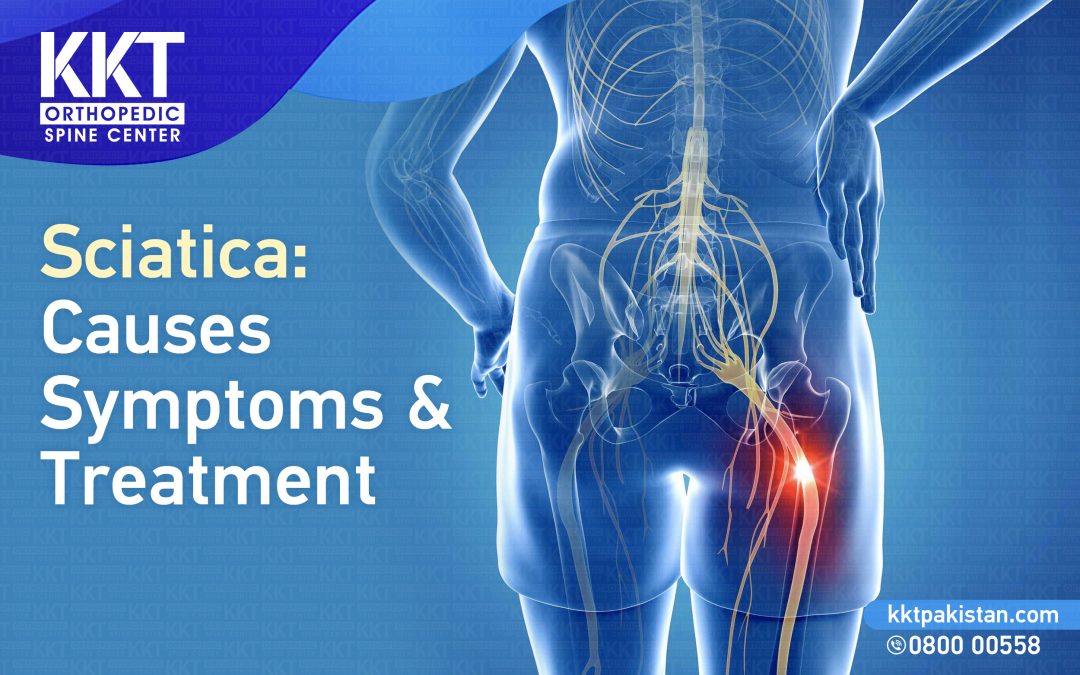 Sciatica: Causes Symptoms and Treatment